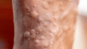 Ant bites on top of foot