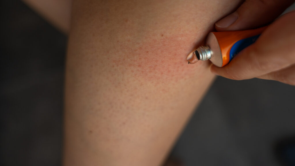 Yellow jacket sting treatment
